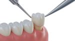 what is a cerec same-day crown and how does it work