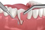 chao pinhole technique for gum recession