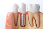 dental implants cost