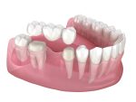 how much does a dental bridge cost