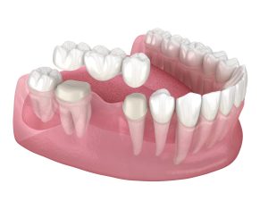 how much does a dental bridge cost
