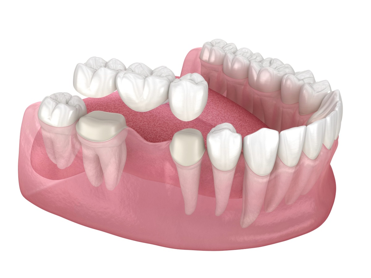 how much does a dental bridge cost