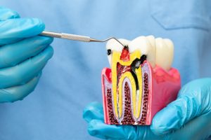 what is a root canal and why do i need one